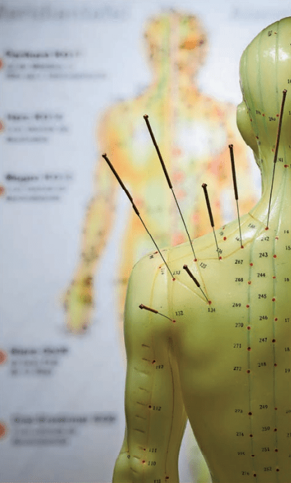 A close up of acupuncture needles on the back of a body
